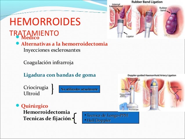 hemorroidectomia tecnica quirurgica